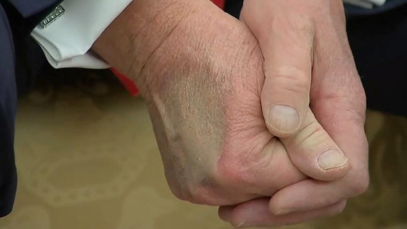 Trump Bruise